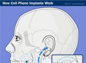 Cómo funcionan los implantes de teléfonos celulares 